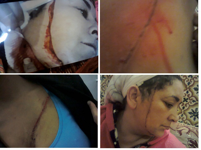 مواطنة تناشد القضاء العادل بإنصافها ؟ أصيبت بجرح غائر أمام أعين أطفالها من طرف المعتدي بعقر دارها