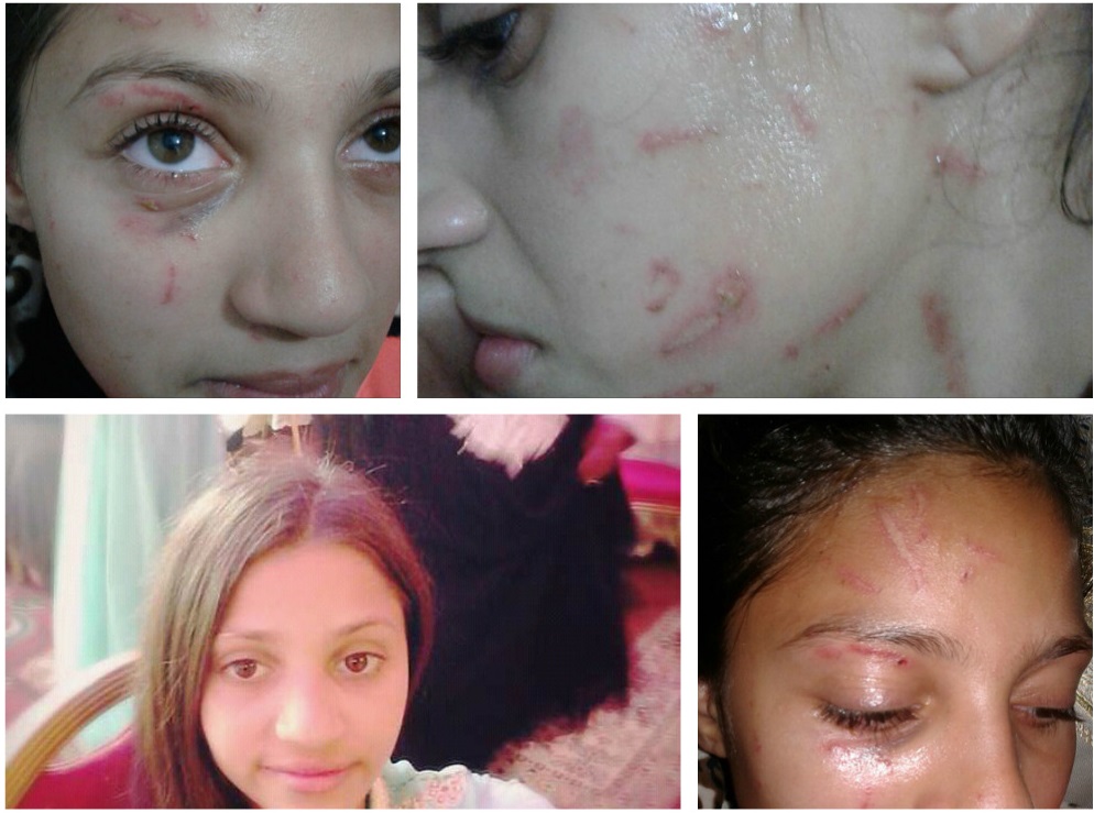 أسرة تلميذة بالجديدة تتهم تلميذتين بتعنيف ابنتهم القاصر وتطالب بالانصاف