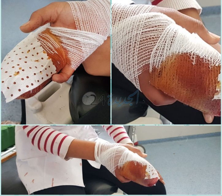 تلميذة تبتر أوتار أصبع زميلتها بواسطة السلاح الابيض بسيدي بنور