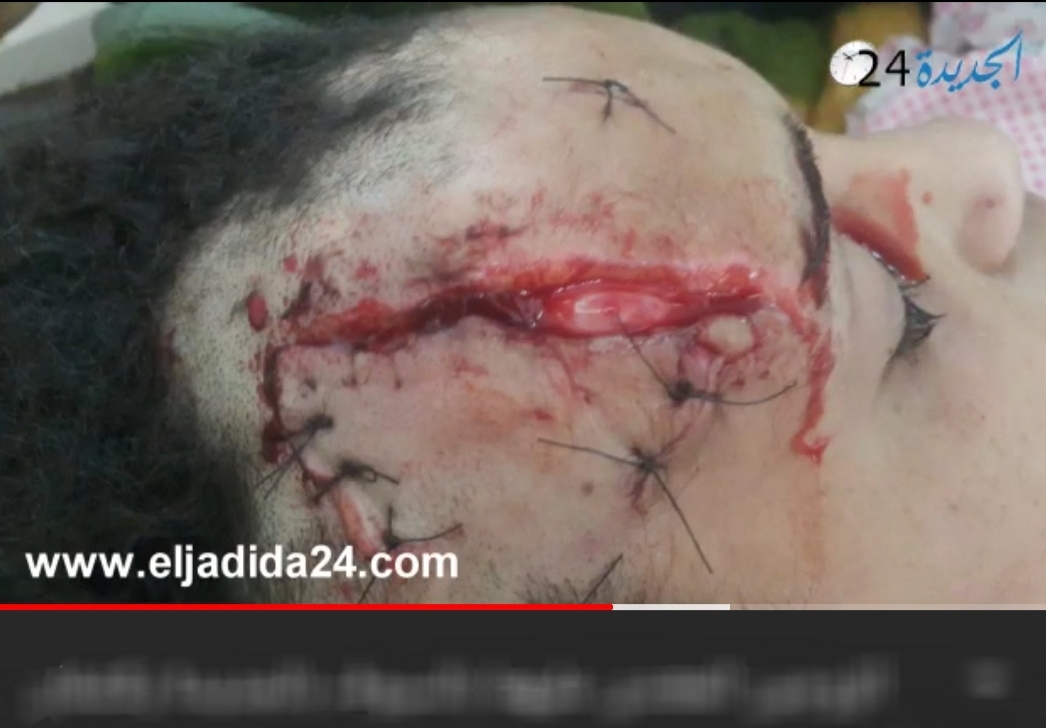 شاهد.. الزوجان المعتدى عليهما بالسيوف بالجديدة يكشفان تفاصيل صادمة حول ما جرى ليلة الاعتداء