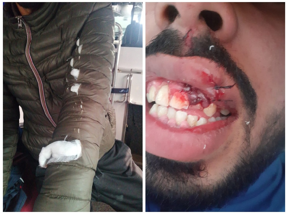 بالصور.. الاعتداء على مراقبي حافلة للنقل الحضري بالجديدة بالحجارة والسلاح الأبيض